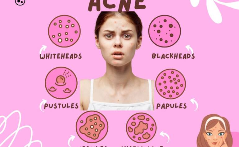 Clear Skin Solutions: The Ultimate Guide to Effective Acne Treatment